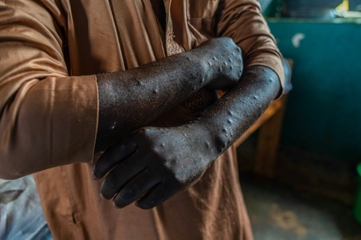 Un patient infecté par le mpox à Kamituga, le 20 septembre 2024 dans l'est de la RDC © Glody MURHABAZI